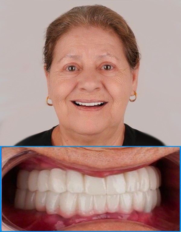 After full mouth dental implants — patient from Auckland New Zealand