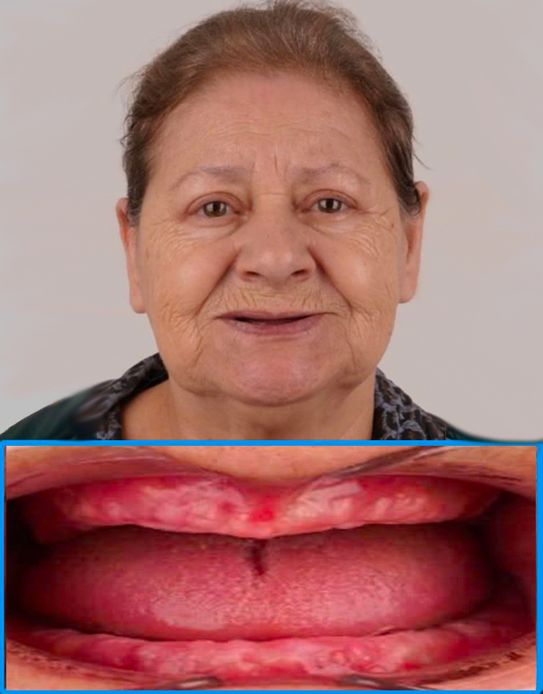 Before full mouth dental implants at Viet Bi Dental Vietnam