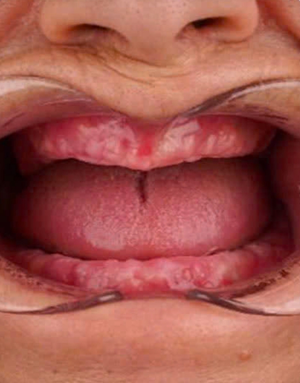 Before implant-supported dental bridge at Viet Bi Dental Clinic